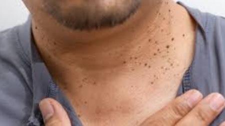 Seborrheic Keratosis